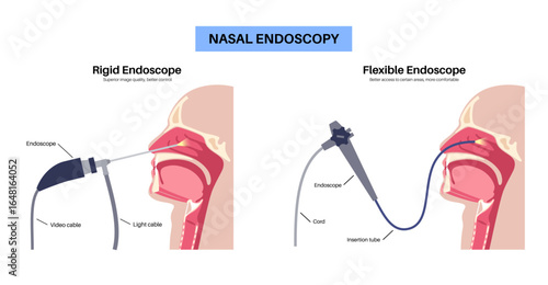 Nasal endoscopy poster
