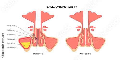 Balloon sinuplasty poster