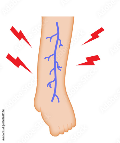 nerve pain neuropathy leg disease leg pain spasm cramp.eps