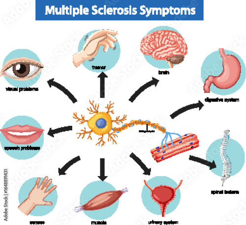 Vector Diagram Illustrating Multiple Sclerosis Symptoms and Effects
