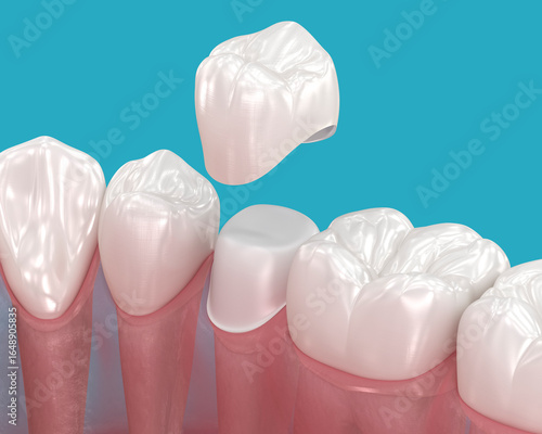 Dental crown placement over tooth. 3D illustration