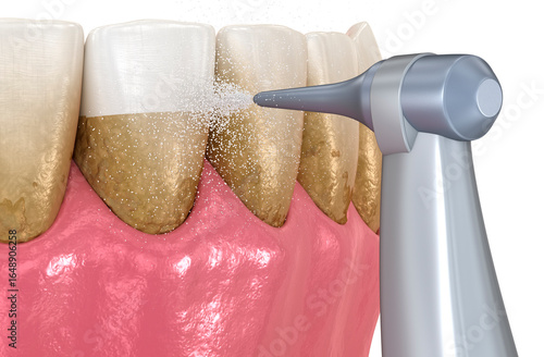 Oral hygiene: Air flow teeth cleaning process. Dental 3D illustration