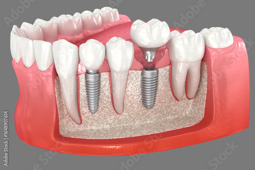 Premolar and Molar tooth implant installation. 3D illustration of dental treatment