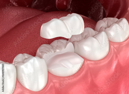 Onlay ceramic crown placement. Medically accurate 3D illustration