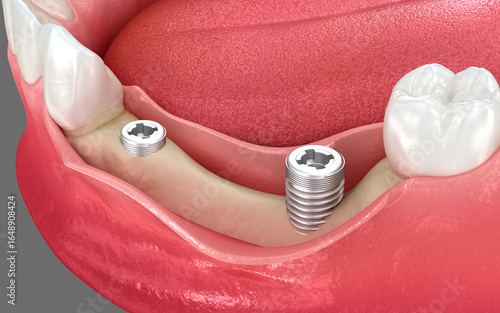 Dental implants and bone lost. 3D illustration