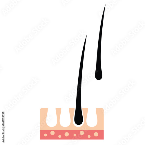 Hairloss vector illustration. Hairloss draw