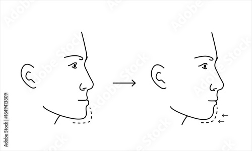 Plastic surgery of young man protruding chin to reshape before and after chart. Line minimalist style drawing.