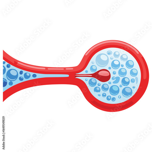 Atherosclerosis Disease Affecting Blood Flow in the Artery