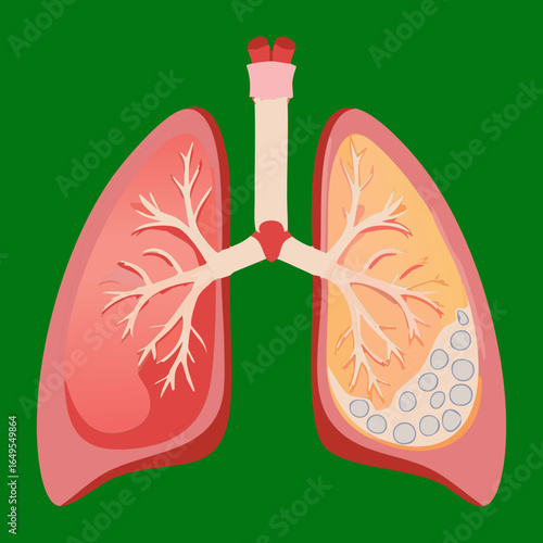 Human Lungs Anatomy with Bronchitis Disease Diagram
