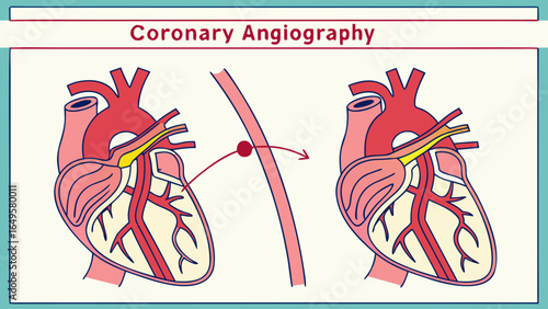 Illustration showing coronary angiography procedure with catheter insertion into the heart vessels depicted twice created with generated ai