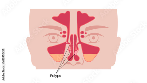 Nasal polyps poster