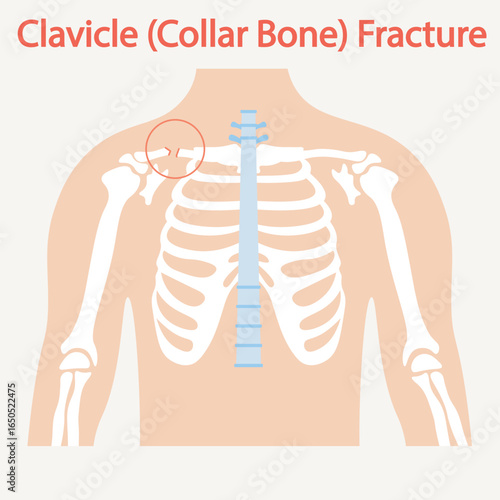 Medical vector of clavicle (collar bone) fracture showing pain, swelling, deformity, limited arm motion; resembles shoulder dislocation, sprain, or rotator cuff injury.