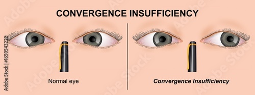 Photos Convergence Insufficiency binocular vision system