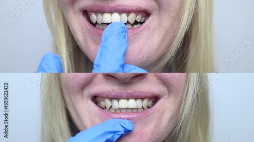 Successful restoration of front incisors. High-quality before and after photos of artistic dental restoration. Tooth build-up and reconstruction for a healthy smile.