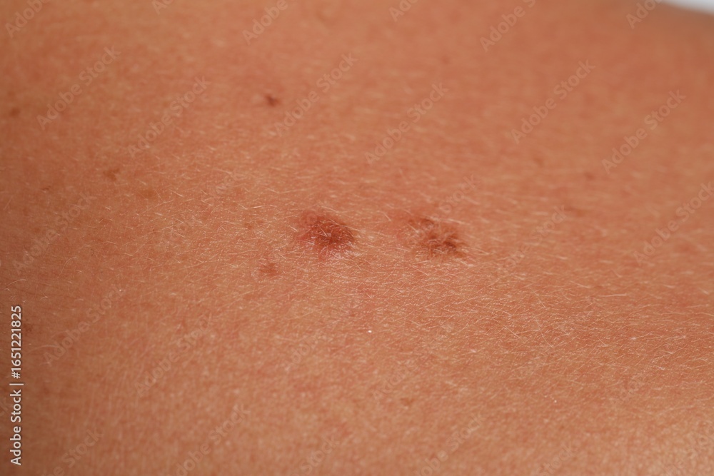 Fototapeta premium Woman with moles on her body, closeup