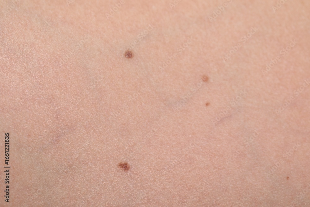 Fototapeta premium Woman with moles on her body, closeup