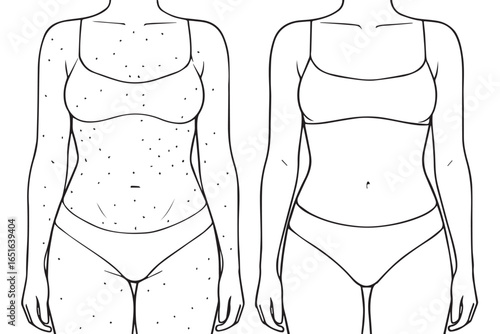 Liposuction healthcare lineart before and after body transformation, showing body contouring and surgery effects