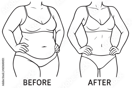 clinical comparison of body silhouette before and after liposuction with lines marking surgery areas, body sculpting, liposuction healthcare lineart