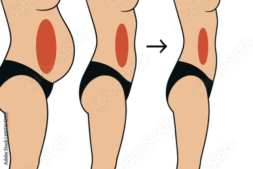 Abdominal Transformation Procedure, Liposuction Process Steps, Liposuction Healthcare Lineart