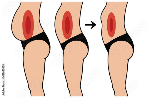 Fat Removal and Body Shaping with Liposuction, Abdominal and Thigh Transformation, Liposuction Healthcare Lineart