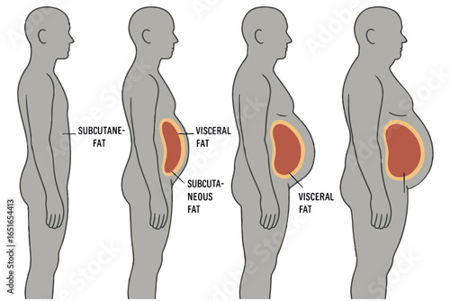 Stages of abdominal fat accumulation, subcutaneous and visceral fat, progressive body fat distribution, weight gain visual abdominal fat healthcare lineart