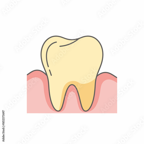 An illustration of a yellow, unhealthy molar tooth with plaque buildup along the pink gum line.