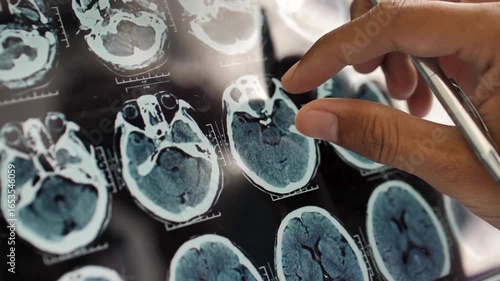 Doctor's hand using pen to pointing at brain x-rays on digital tablet. Doctor analyzing CT or MRI Brain Scan Images. Brain X-ray image on Digital Tablet.