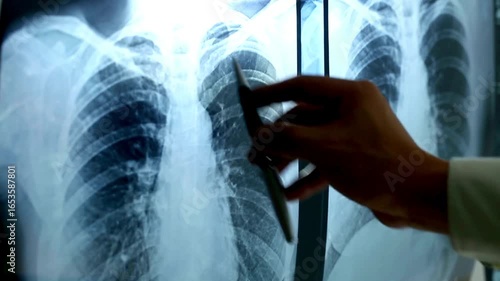 Doctor hands with medical x ray of chest scan on light background pointed with pen. doctor examining patient lungs x-ray film at radiology department.