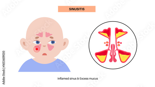 Sinusitis medical poster