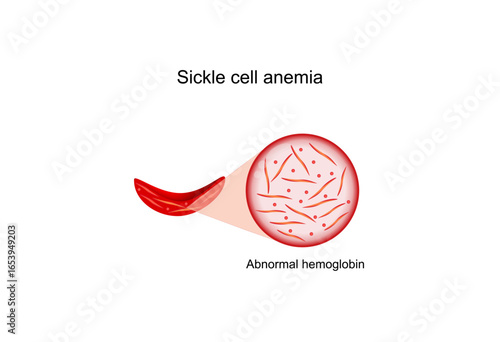 Sickle cell anemia, disease. Sickle cell, abnormal hemoglobin. Gene mutation. Vector illustration.