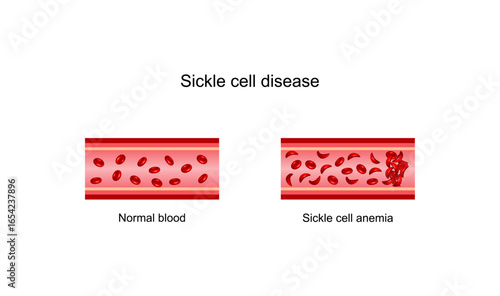 Sickle cell disease. Normal blood and Sickle cell anemia,. Gene mutation. Vector illustration.