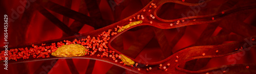 3D medical concept showing artery plaque formation due to high LDL cholesterol, poor nutrition, excessive sugar intake, alcohol consumption, and lack of exercise leading to heart disease. 3D rendering