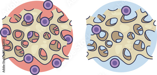 A medical illustration comparing healthy, cell-rich bone marrow with hypocellular marrow in aplastic anemia, showing a severe deficiency of hematopoietic stem cells and blood cell production.
