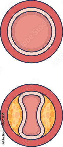 A medical illustration comparing a healthy, open artery with one narrowed by arterial stenosis. The stenotic artery shows plaque buildup (atherosclerosis), which restricts blood flow.