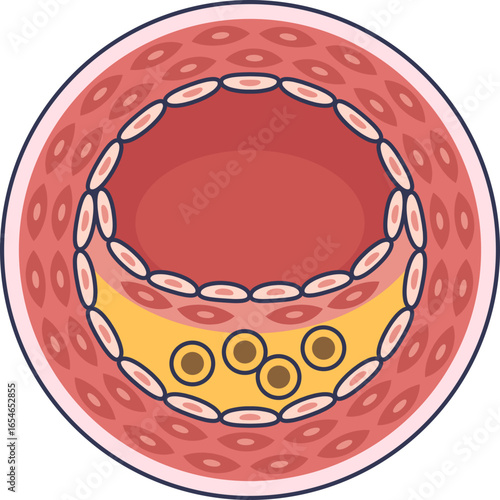 A medical illustration showing a cross-section of an artery with atherosclerotic plaque. Cholesterol and fat deposits narrow the arterial lumen, representing stenosis and cardiovascular disease.