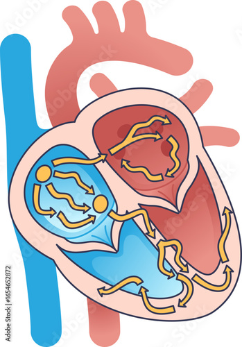 Medical illustration of a heart with Atrial Fibrillation, showing chaotic electrical signals in the atria. This visual represents the cause of an irregular heartbeat and arrhythmia.