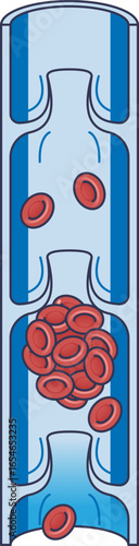 Medical illustration of Deep Vein Thrombosis (DVT). A blood clot, or thrombus, formed by red blood cells obstructs blood flow within a deep vein, highlighting a serious vascular condition.