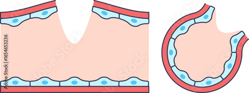 Diagram of a damaged blood vessel wall. Shows cross-section and longitudinal views of a vascular injury with a break in the endothelial lining, exposing the subendothelial layer.