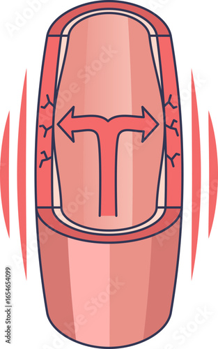 Medical illustration of a blood vessel under high pressure. Arrows show force on arterial walls, symbolizing hypertension and vascular damage to the endothelium.