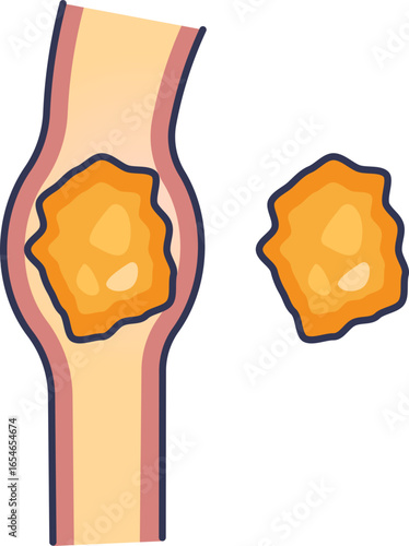 Medical illustration of a kidney stone obstructing the ureter. This diagram shows a large renal calculus causing a blockage in the urinary tract, representing urolithiasis.