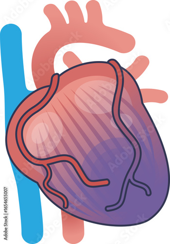 Illustration of a heart with a discolored purple area, representing muscle damage from a myocardial infarction. Shows coronary arteries and major vessels.