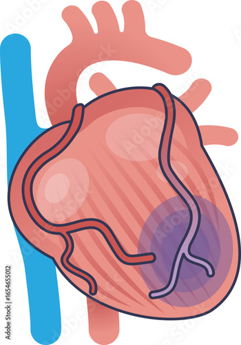 Medical illustration of myocardial ischemia. A discolored area on the heart muscle shows tissue damage from a blocked coronary artery, representing reduced blood flow and oxygen.