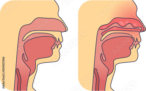 Medical illustration comparing a normal nasal passage with a congested one. The diagram shows inflamed, swollen nasal tissues causing a stuffy nose, a symptom of rhinitis or sinusitis.