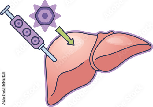 Illustration of pancreatic islet cell transplantation. A syringe injects islet cells into the liver, a procedure to treat type 1 diabetes by restoring insulin production.
