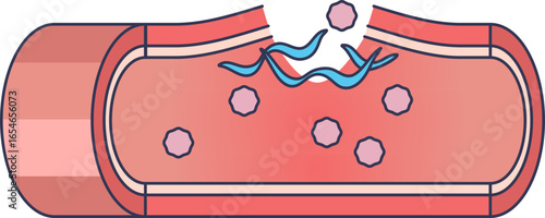 Illustration of a damaged blood vessel where platelets fail to adhere to exposed collagen. This visualizes a platelet adhesion defect, a key issue in bleeding disorders and impaired hemostasis.