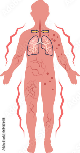 Medical illustration of systemic anaphylaxis symptoms. Shows a human figure with skin rash, hives, and respiratory distress, indicating a severe, body-wide allergic reaction and anaphylactic shock.