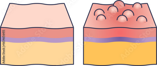 A medical diagram comparing normal skin layers to skin with hives. It illustrates the formation of raised, red welts (urticaria) on the epidermis due to an allergic reaction and inflammation.