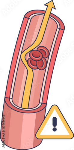 Illustration of a blood vessel with a clot blocking flow, representing a Transient Ischemic Event (TIA). A warning sign highlights the risk of a mini-stroke and brain ischemia.