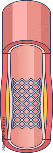 Medical illustration of an angioplasty stent inside a coronary artery. The mesh device expands the vessel, compressing atherosclerotic plaque to restore blood flow and treat heart disease.