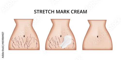 Woman applying stretch mark cream for skin care treatment